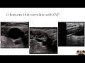 evaluation of the jvp with pocus an in depth guide