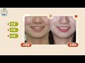 整牙能拯救你的脸吗？能不能整牙如换头？can teeth reshaping save your looks can teeth reshaping be like facelifting