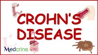 CROHN'S DISEASE causes,pathophysiology,clinical features,diagnosis and treatment