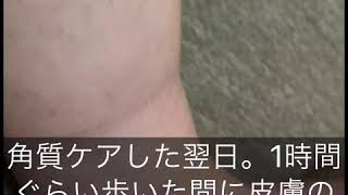 【閲覧注意】蜂窩織炎（ほうかしきえん）蜂巣炎（ほうそうえん）Cellulitis