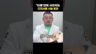 다크서클, 더 이상 고민하지 마세요! | 피부과전문의 김홍석