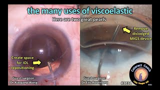 CataractCoach 1231; the many uses of viscoelastics (OVD) in cataract surgery