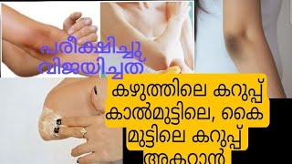 How to get rid of blackheads on the neck|കഴുത്തിലെ കറുപ്പ് കൈ, കാൽ മുട്ടിലെ കറുപ്പ് അകറ്റാൻ