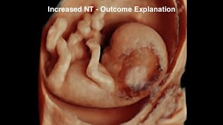 Increased Nuchal Translucency