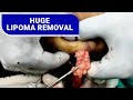 Multiple Lipoma Removal under local anesthesia by Dr. Prashant Yadav