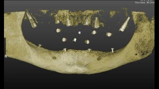 One Day Digital Dentistry. NAVIDENT V2.2 Total Edentulous Protocol - Lower Jaw. Dr. L.V. STEFANELLI