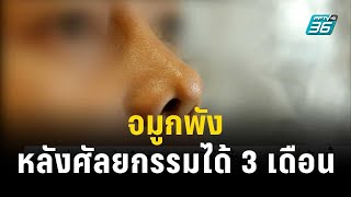 ผู้เสียหายร้องคลินิกย่านรัชดา ทำจมูกพังหลังศัลยกรรมได้ 3 เดือน | โชว์ข่าวเช้านี้ | 8 พ.ย. 66