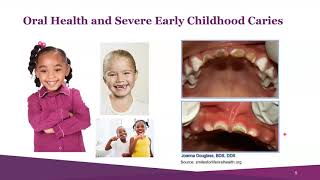 Webinar: Promoting Use of Childhood Dental Benefits Covered Under Medicaid & CHIP (2/18/21)