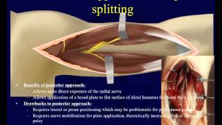 Humeral Shaft Fractures 2 - Surgical techniques (OTA lecture series III u04b)