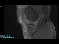 mri case review complex tear in knee meniscus