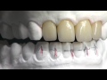 Veneering of Lithium Disilicate by Stefano Lombardo and Diego Foletto