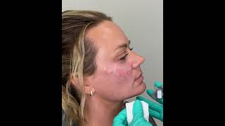 Cheek Filler Injection, Faces, pllc