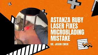 ASTANZA RUBY LASER FIXES MICROBLADING MISTAKE | Dr. Jason Emer