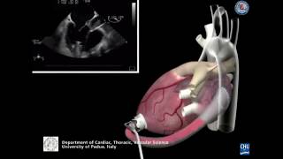 Implantation d’une assistance cardiaque - Jarvik 2000