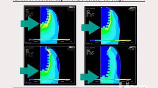 Finite Element Analysis of Various Implant Designs Including Bicon's 6.0mm x 5.7mm Implant