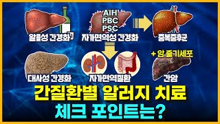 간질환별 알러지 치료 효과 공개 (간경화, 간암, 자가면역성, 대사성, 지방간, 알콜성, 중복증후군)