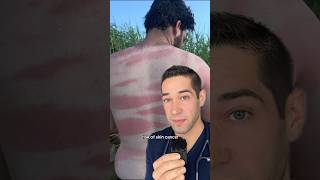 Doctor Reacts: extreme sunburn!
