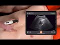 gallbladder ultrasound