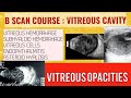 B scan course || learn how to  B scan vitreous opacities