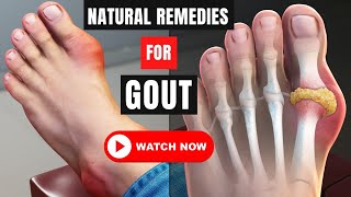 Home Remedies For Gout  | How To Reduce Gout Naturally | Fit&Fab