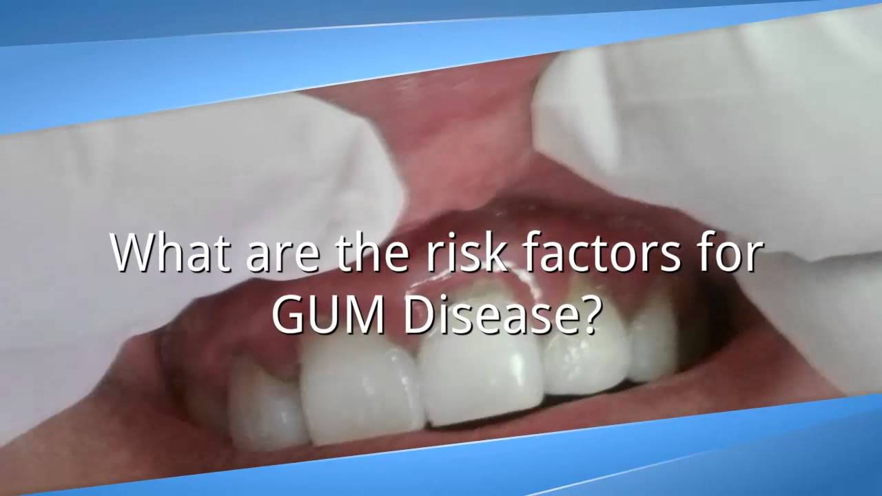 Knowing And Understanding Gum Disease | What Is Gum Disease - Stop Gum ...