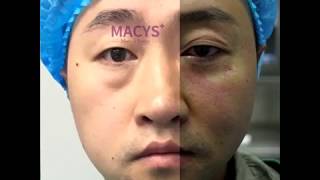 美詩沁去眼袋 讓你大叔變帥哥 | Macys Medical Beauty