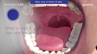 Tonsils Information | Tonsils Treatment By Dr. Rajesh Bhardwaj | #Tonsillitis #Tonsiltreatment Hindi