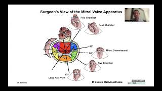 5. Echocardiographic Assessment of Minimally Invasive Mitral Valve Repair - Dr. Massimiliano Meineri