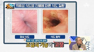 '당신의 식도가 신음한다' 역류성 식도염 진행에 따른 식도 질환! | 나는 몸신이다 261 회