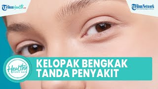 Keluhkan Kelopak Mata Bengkak Bisa Jadi Tanda Masalah Serius: Adanya Alergi dan Herpes Okular