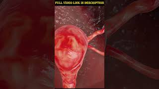 महिला नसबंदी कैसे होती है? | Female Sterilization Explained in 3D Animation