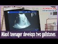 Miaoli teenager develops two gallstones｜Taiwan News