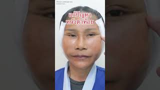 ดึงหน้าแก้ปัญหาหนังตาตก #parinclinic #facelift #shorts