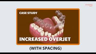 Complete Transformation Of Increased Overjet With Spacing (Aligner Treatment) on Archform💻