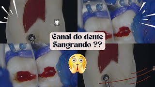 O que fazer quando o canal não para de sangrar  | Resumos de Odonto