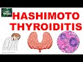 Hashimoto Thyroiditis: Etiopathogenesis,  Gross m Microscopy and Clinical Features