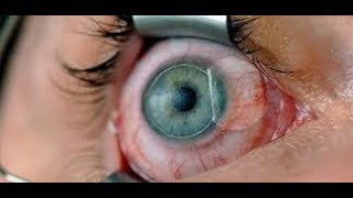 LASIK - Refractive Surgery ~ understand the procedure. LASIK - Refractive Surgery ~ understand the procedure.
