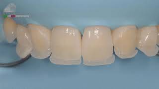 CompoSite di White Dental Beauty