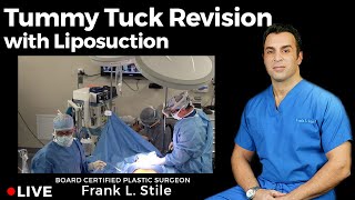 Tummy Tuck Revision with Liposuction Live Surgery