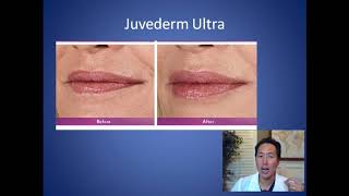 How Can I Plump My Lips - Lip Filler and Fat Grafting Consultation - Dr. Anthony Youn