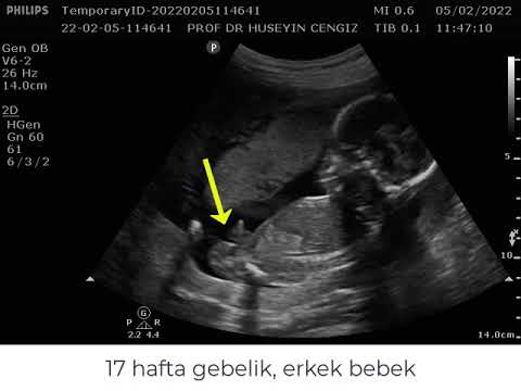 ERKEK BEBEK 👶 ULTRASONDA NASIL GÖRÜNÜR? (anne Karnındaki Erkek Bebek ...