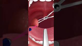 Throt infection || Tonsils  #shorts ||SURGERY #3danimation #doctor #viral