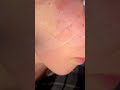 Laser Peel Skin Texture #shorts #shortvideo