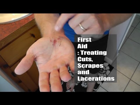 First Aid : Treating Cuts, Scrapes and Lacerations First Aid : Treating Cuts, Scrapes and Lacerations