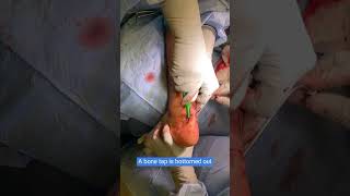 Achilles Tendon Repair Surgery - Arthrex Achilles Midsubstance SpeedBridge Repair System