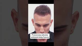 Zakola, łysienie… Postanowiłem z tym walczyć! #przeszczepwlosow #hairtransplant #hair #metamorfoza