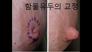 함몰유두의교정