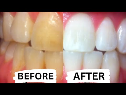 How To Whiten Teeth at Home in 3 Minutes How To Whiten Teeth at Home in 3 Minutes