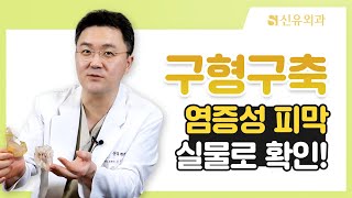 염증성 피막 실물! | 신유외과 SHINYU CLINIC