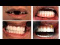 chrome guidedsmile full arch prosthetic conversion tips